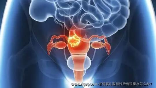 试管婴儿取卵过后出现腹水怎么办？