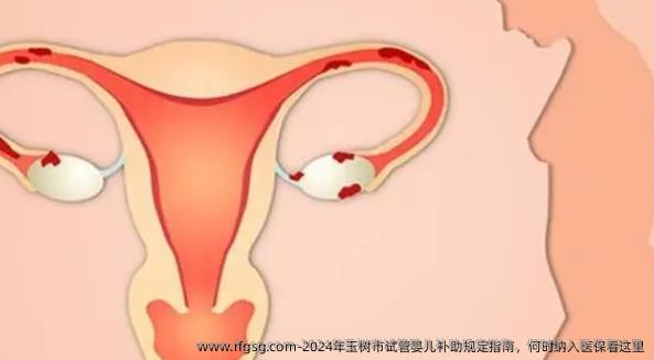 2024年玉树市试管婴儿补助规定指南，何时纳入医保看这里