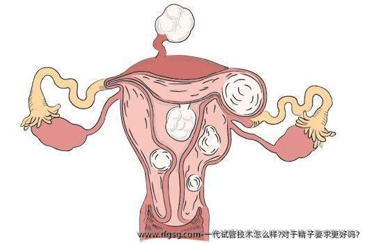 一代试管技术怎么样?对于精子要求更好吗?