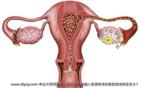 中山大学附属第二医院做胚胎植入前遗传学诊断的成功率是多少？