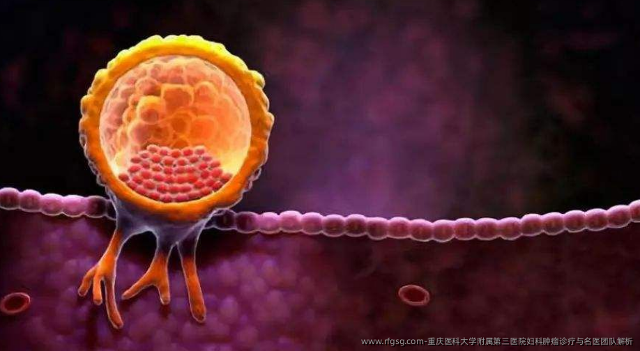 重庆医科大学附属第三医院妇科肿瘤诊疗与名医团队解析