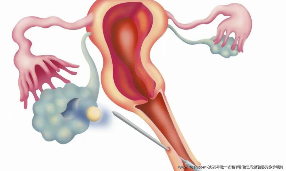 2025年做一次俄罗斯第三代试管婴儿多少钱啊