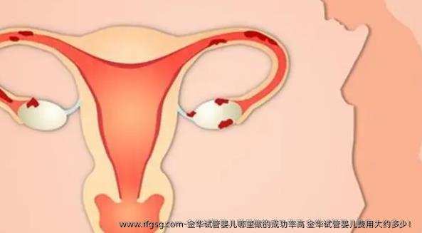 金华试管婴儿哪里做的成功率高 金华试管婴儿费用大约多少！