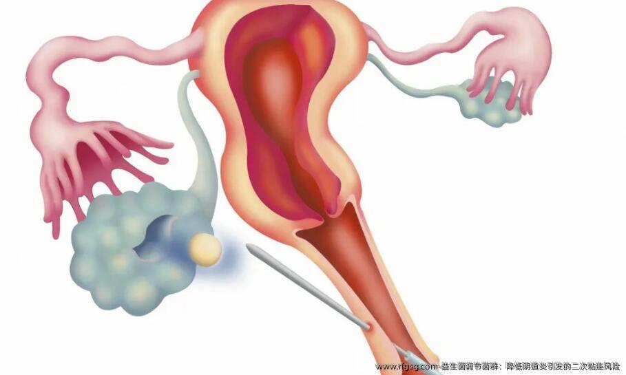 ‌益生菌调节菌群：降低阴道炎引发的二次粘连风险‌