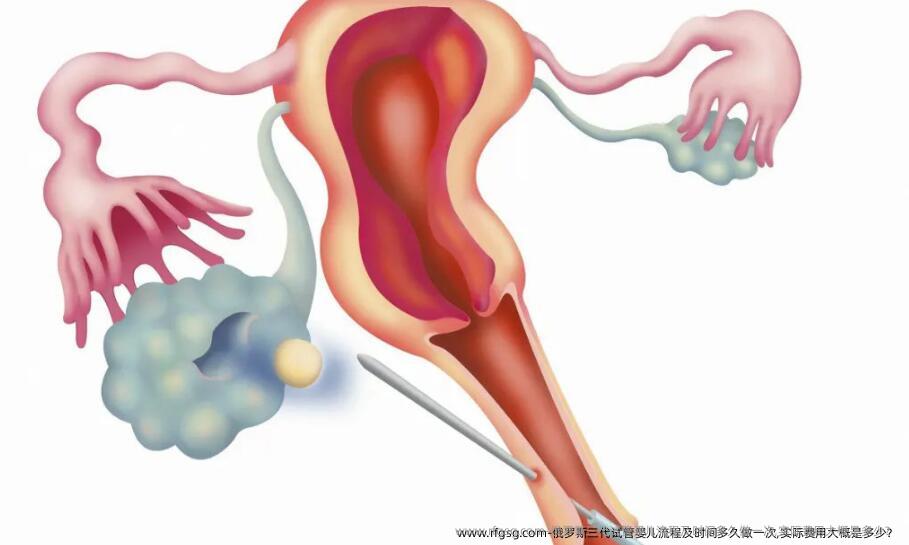 俄罗斯三代试管婴儿流程及时间多久做一次,实际费用大概是多少？