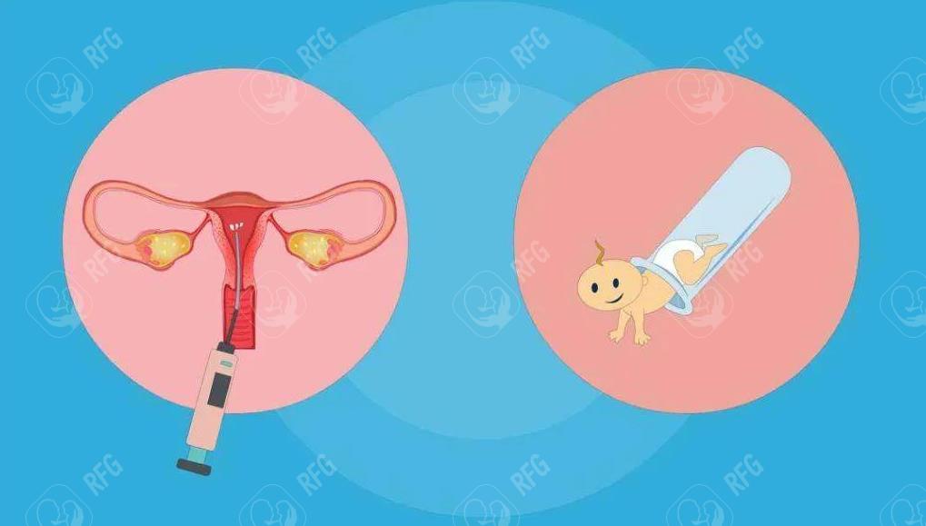 炎症控制后多久可以开始试管婴儿治疗？